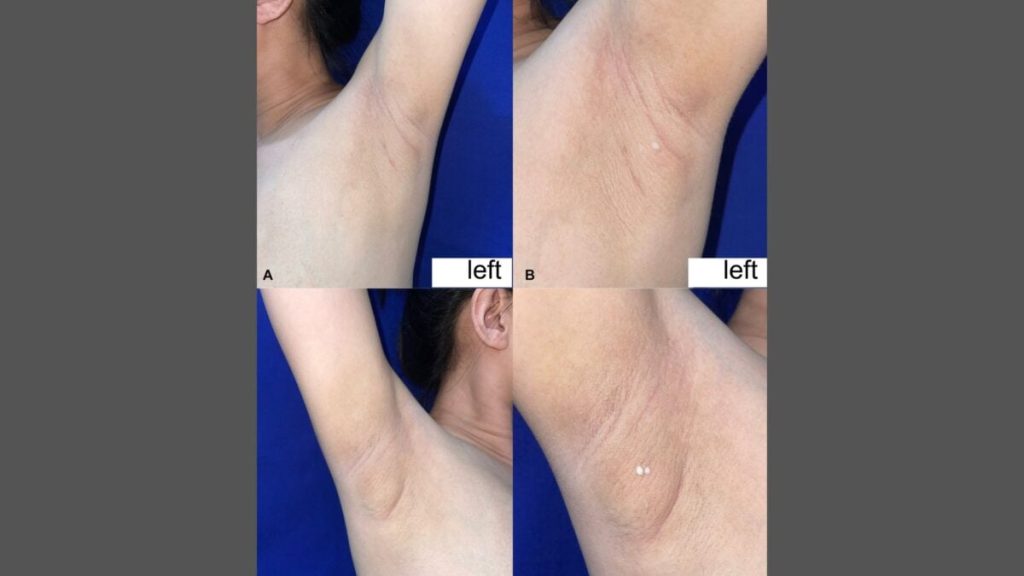 امرأة بحالة نادرة تعاني من تسرب الحليب من الإبط